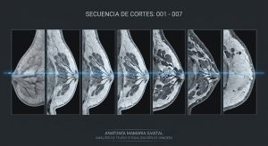 Modelo 3D de tejido mamario denso siendo analizado por tomosíntesis en cortes milimétricos.